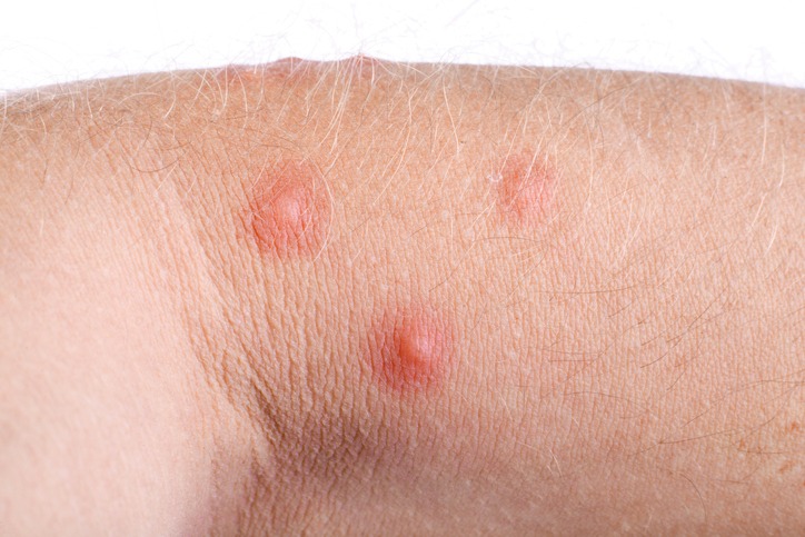 infected mosquito bite blister